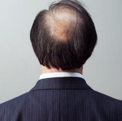 頭發早禿這些常見的食療方法或會越吃越糟!