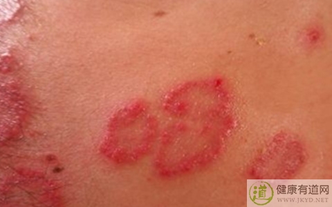 皮毛窦症狀 皮毛窦症狀