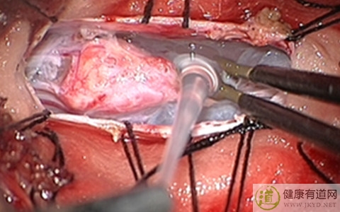 皮毛窦症狀 皮毛窦症狀