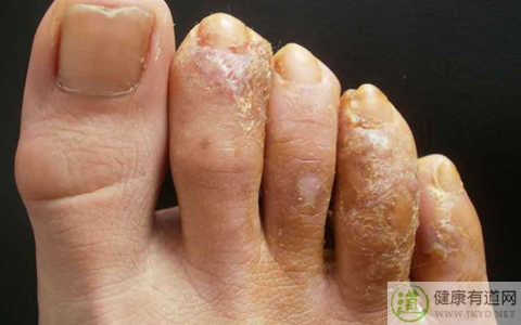 腳癬怎麼治 腳癬怎麼治