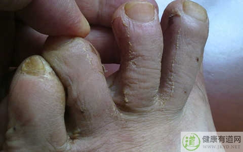 腳癬怎麼治 腳癬怎麼治