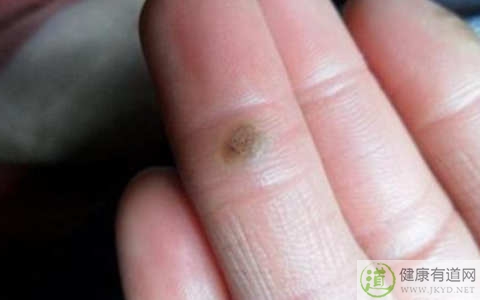 瘊子是什麼 瘊子是什麼