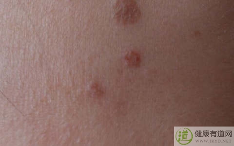 瘊子是什麼 瘊子是什麼