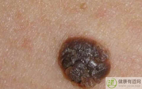 去痣的方法 去痣的方法