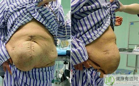 疝氣是什麼 疝氣是什麼