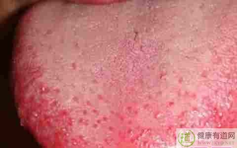 血熱怎麼辦 血熱怎麼辦