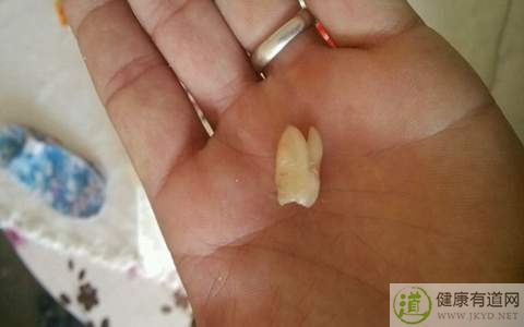 拔牙的危害 拔牙的危害