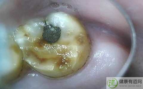 長蟲牙了怎麼辦 長蟲牙了怎麼辦