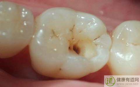 長蟲牙了怎麼辦 長蟲牙了怎麼辦