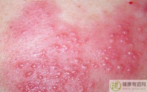 濕疹哪些食物不能吃 濕疹哪些食物不能吃